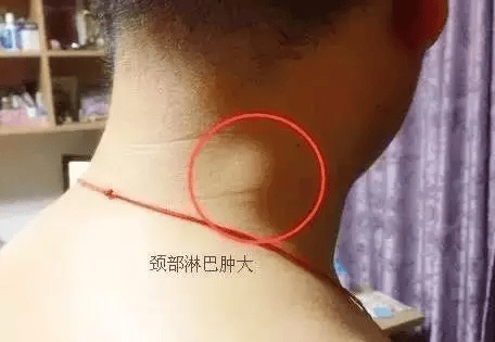 男性腹股沟淋巴结节图片