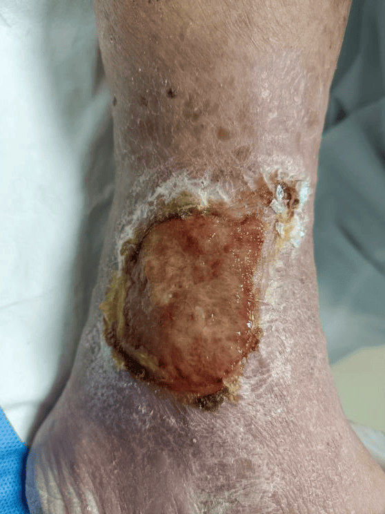 复杂创面(老烂脚)专病门诊开诊啦!