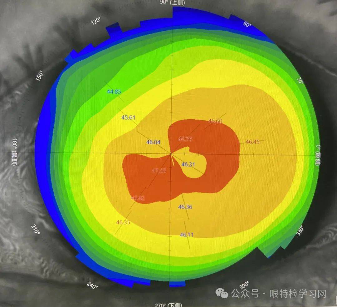角膜地形图高度图分析图片