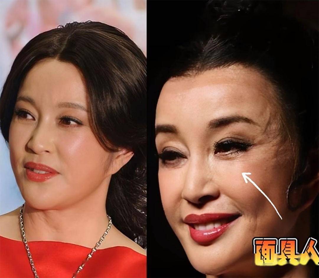 保持年轻,可随着时间的流逝,医美在脸上留下的痕迹比自然衰老更加糟糕