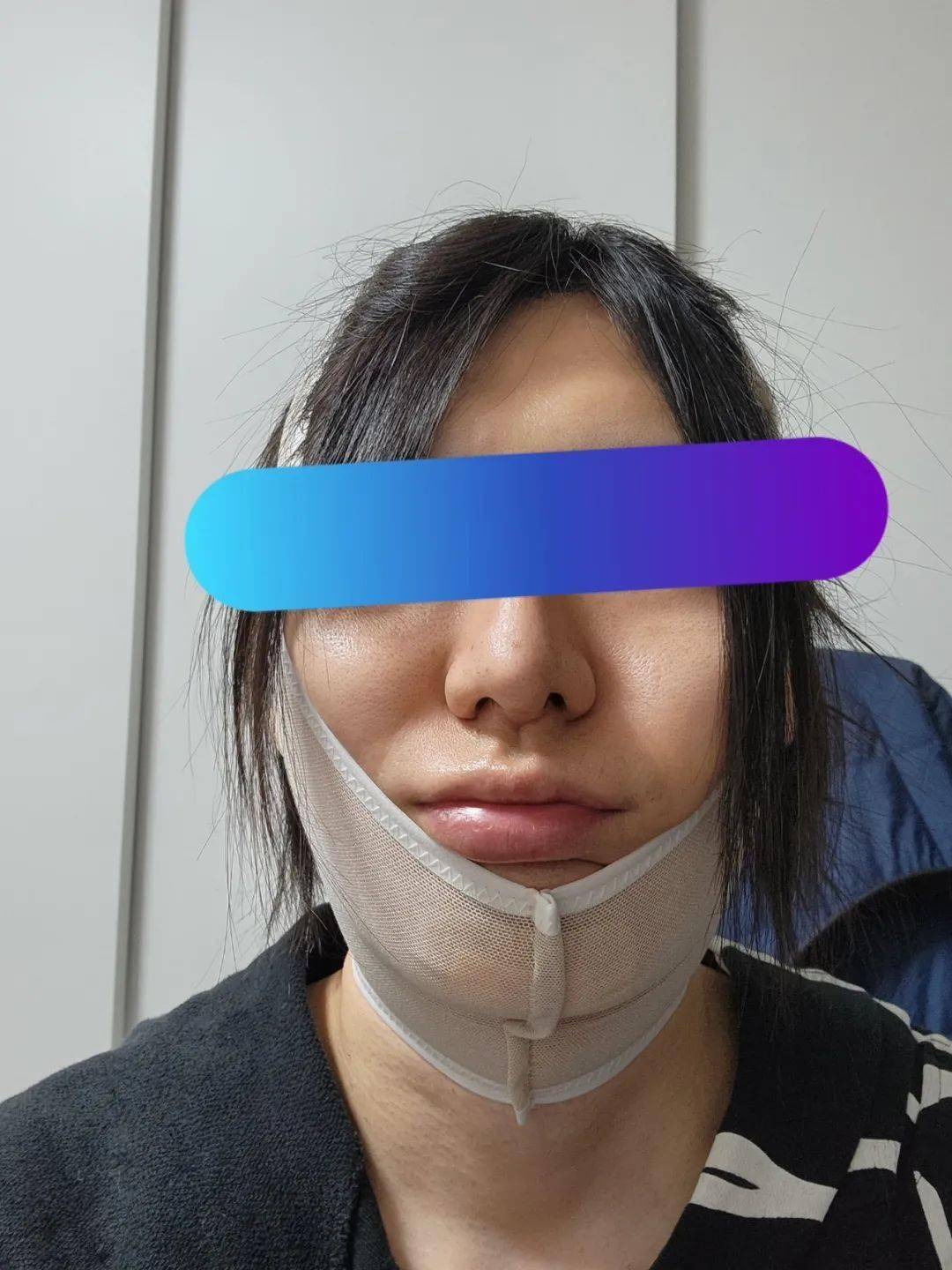 甚至为了改善下颚突出打造一个好看的下巴楠唯又花360万做了个下颌