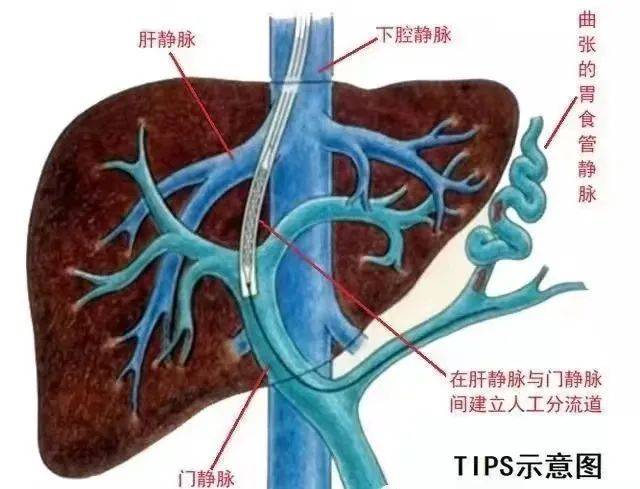 省第四人民医院健康科普——介入治疗经颈静脉肝内门体分流术（tips）