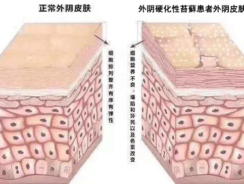 外阴鳞状上皮增生即外阴上皮非瘤样病变,曾经被归为外阴营养不良,俗称