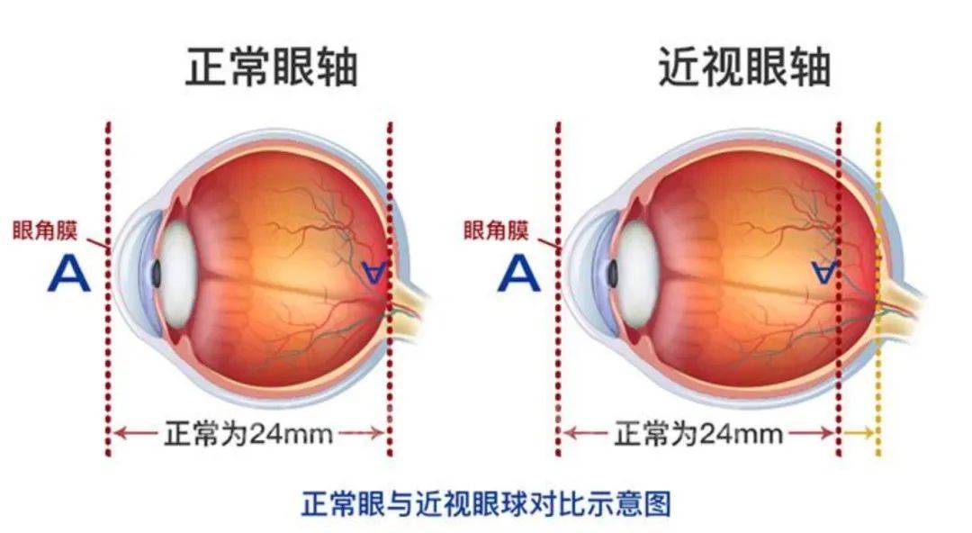 protect your eye主要参考指标眼轴是评估眼球发育的