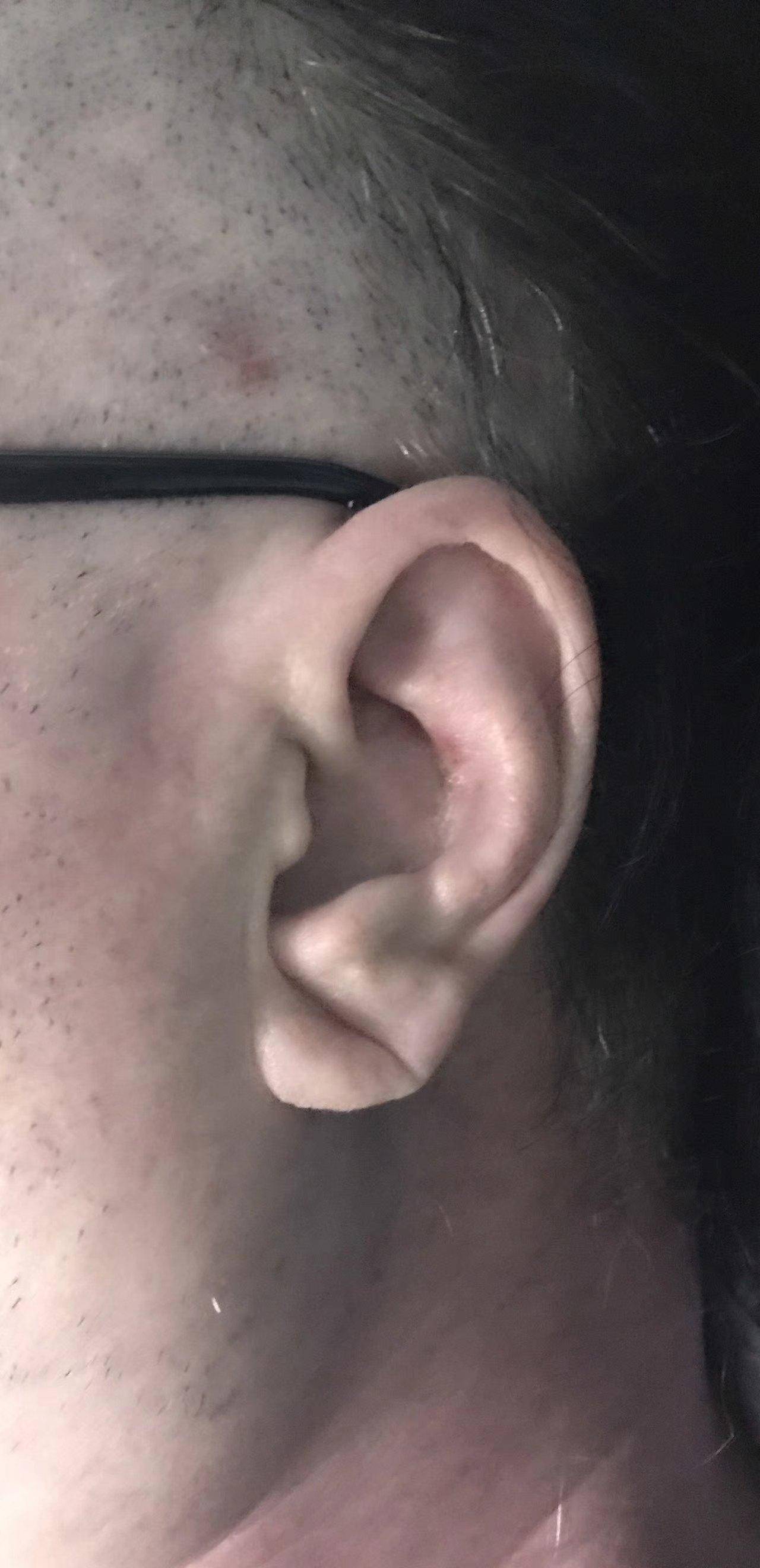 耳垂折痕,真的预示着心肌缺血?心脏病吗?看心血管专家怎么说!