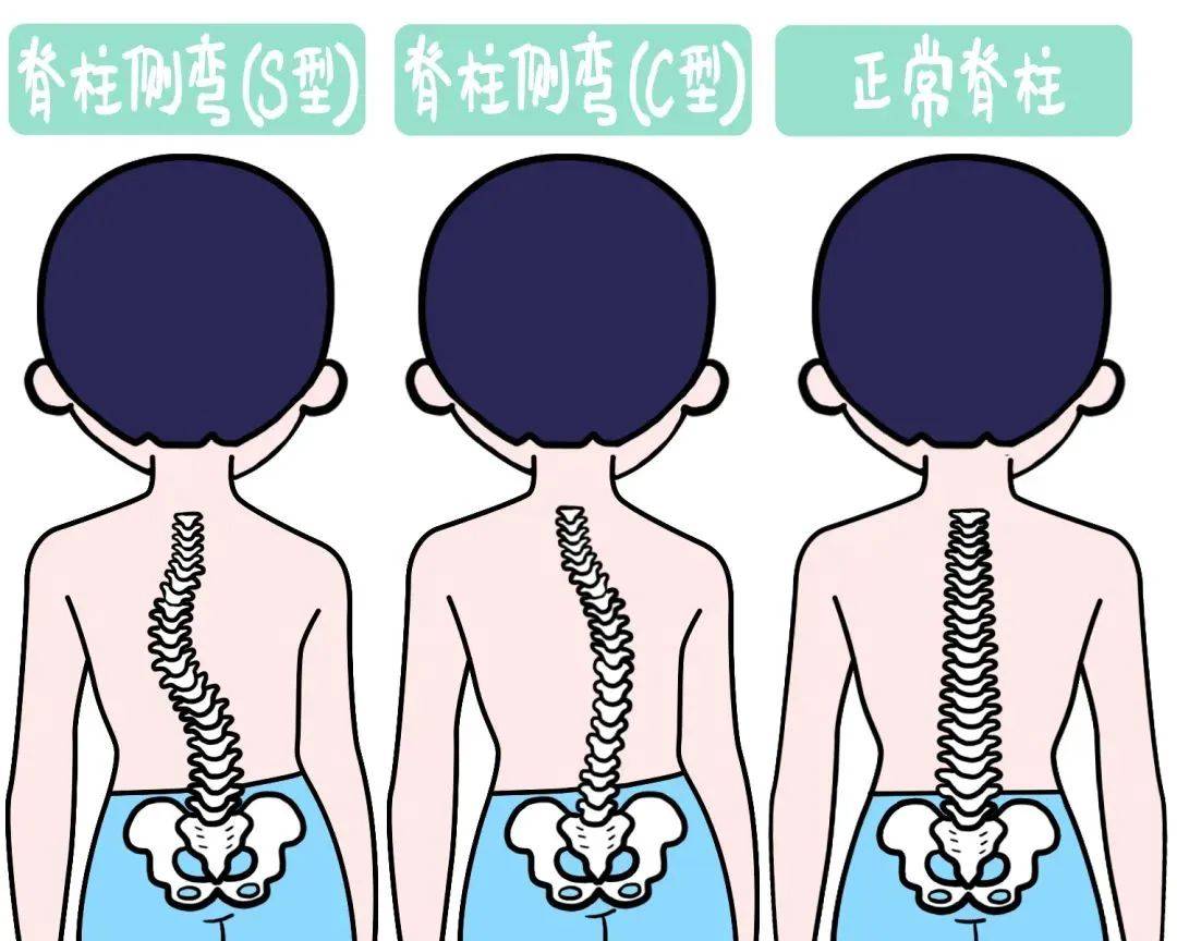 脊柱侧弯10度外观图片