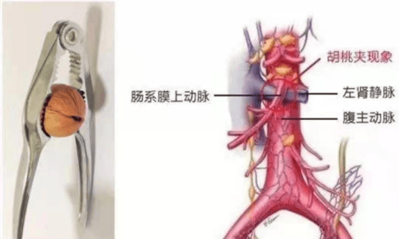 8岁孩子患"胡桃夹综合征",医生叮嘱:多吃些长胖点!