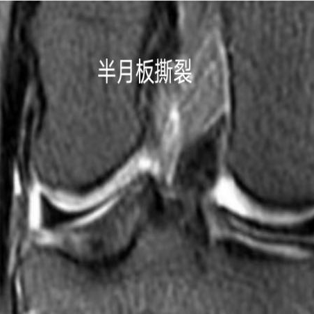 半月板损伤后,患者在下蹲过程中,膝关节部位受力较大,可能会挤压损伤