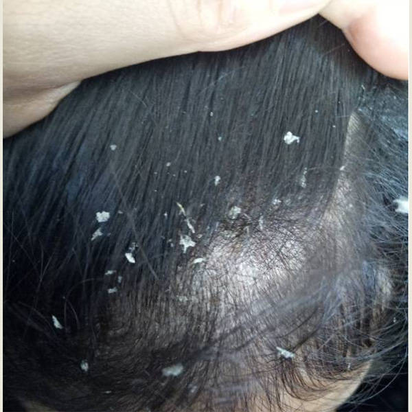 去头皮止痒的洗发水有哪些?青少年去油去屑洗发水推荐