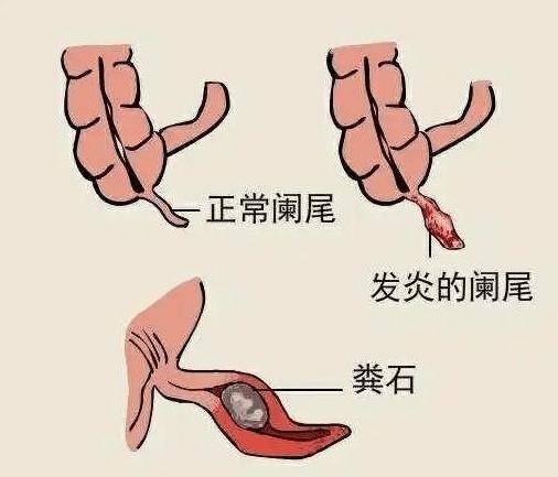 医生:这可不是"吃坏肚子"!