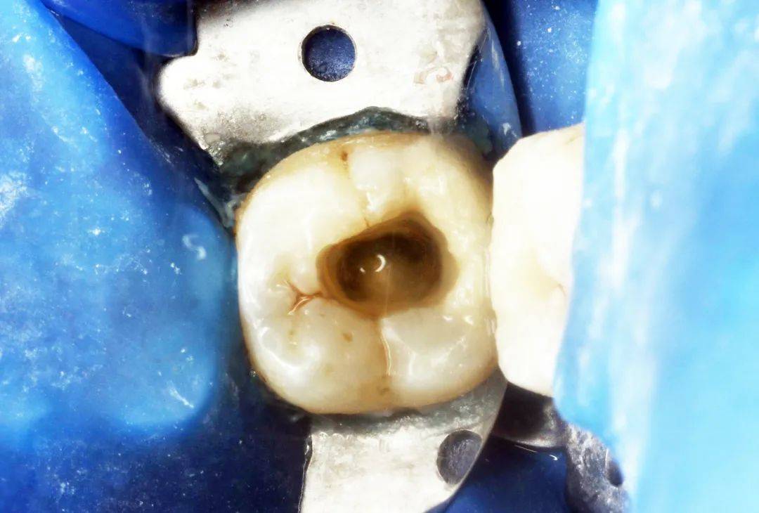 口腔检查:37远中牙颈部龋坏至龈下1mm,穿髓