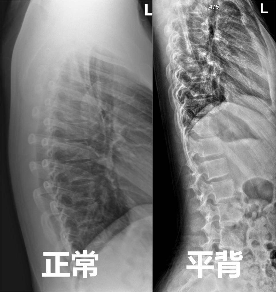 驼背图片侧面图图片