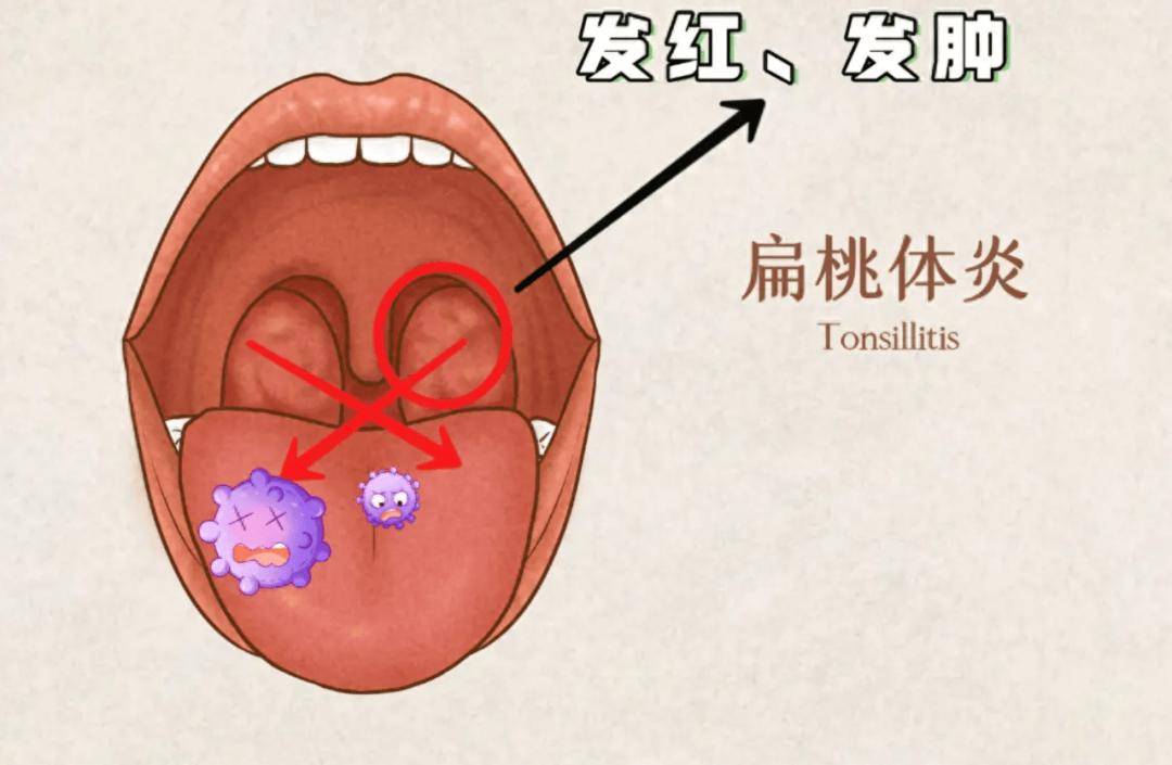 小儿的扁桃体经常发炎是摘还是留?关键看什么?