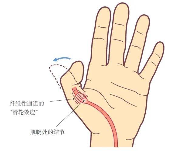 【大众科普】弹响指:狭窄性腱鞘炎知多少?_手指_活动_治疗