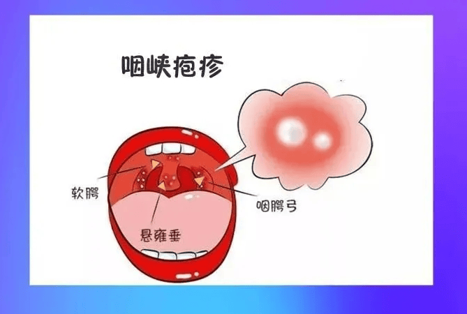 咽峡炎位置图片图片