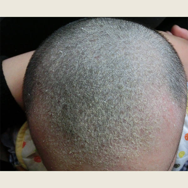 一种可能的原因是脂溢性皮炎,这是一种头皮的常见情况,通常由头皮上的