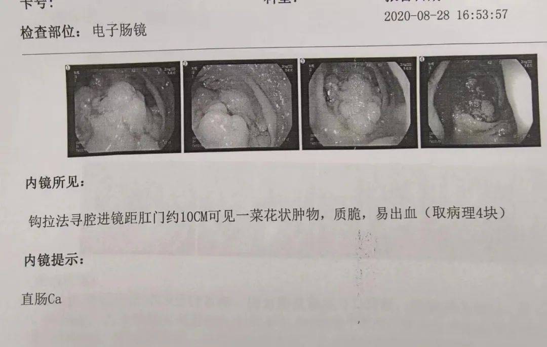 胃出血照片 诊断图片