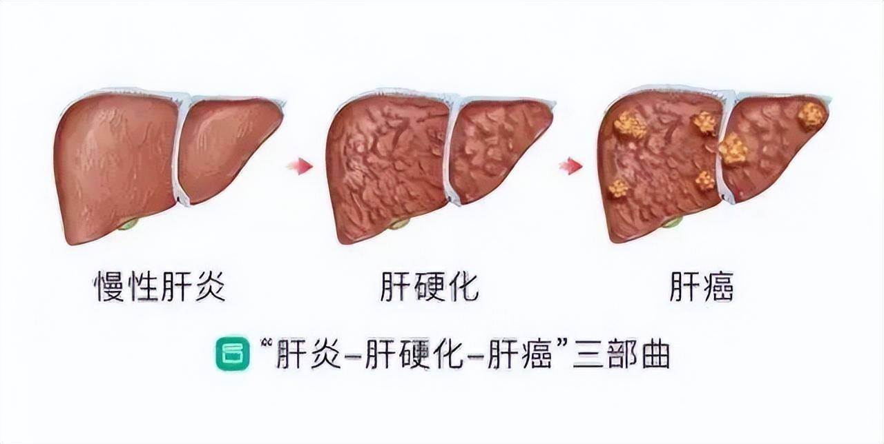 肝肿瘤严重吗图片