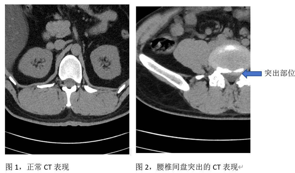 腰椎间盘突出了