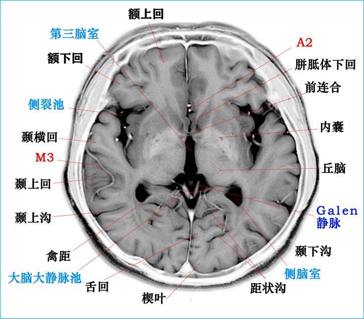 基底节区断层解剖图片