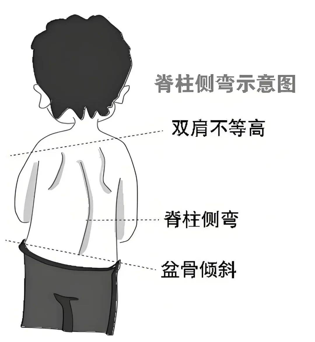 生长发育专家团队将运用先进的评估手段,为孩子进行脊柱侧弯筛查,做到