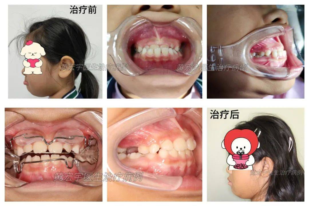 儿童颌骨矫正图片