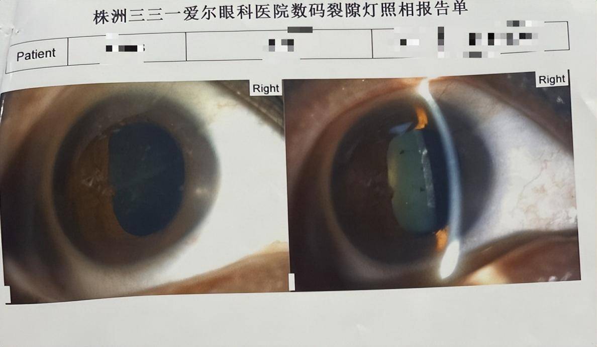 角膜内皮镜检查图片