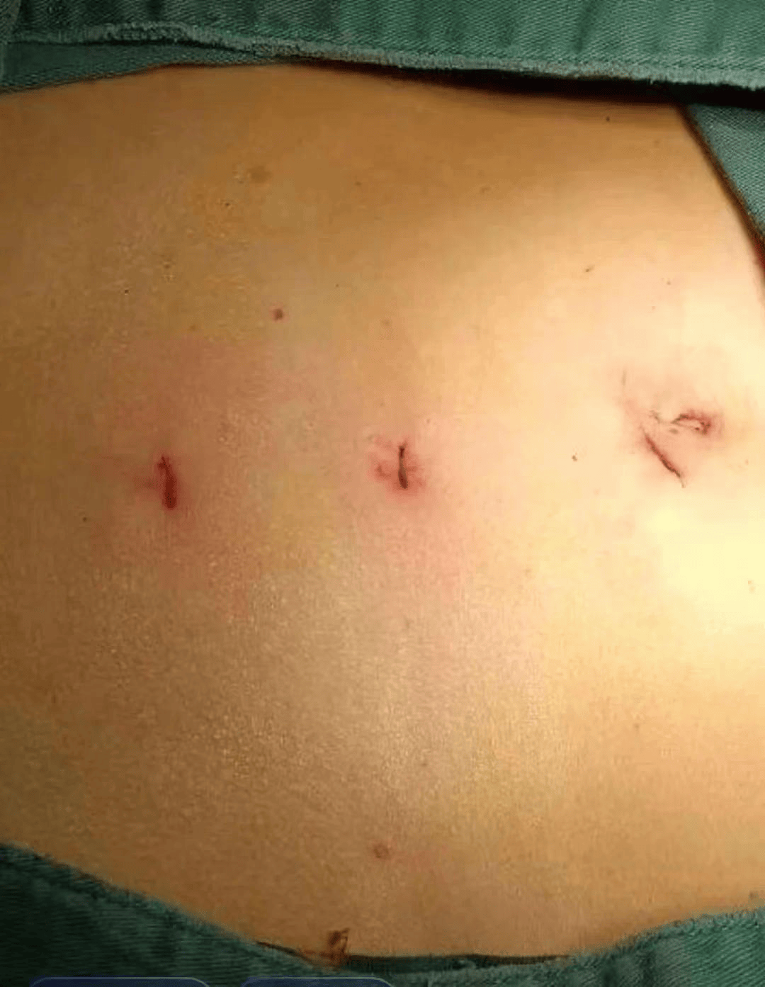 健康科普小切口解决大问题腹腔镜手术