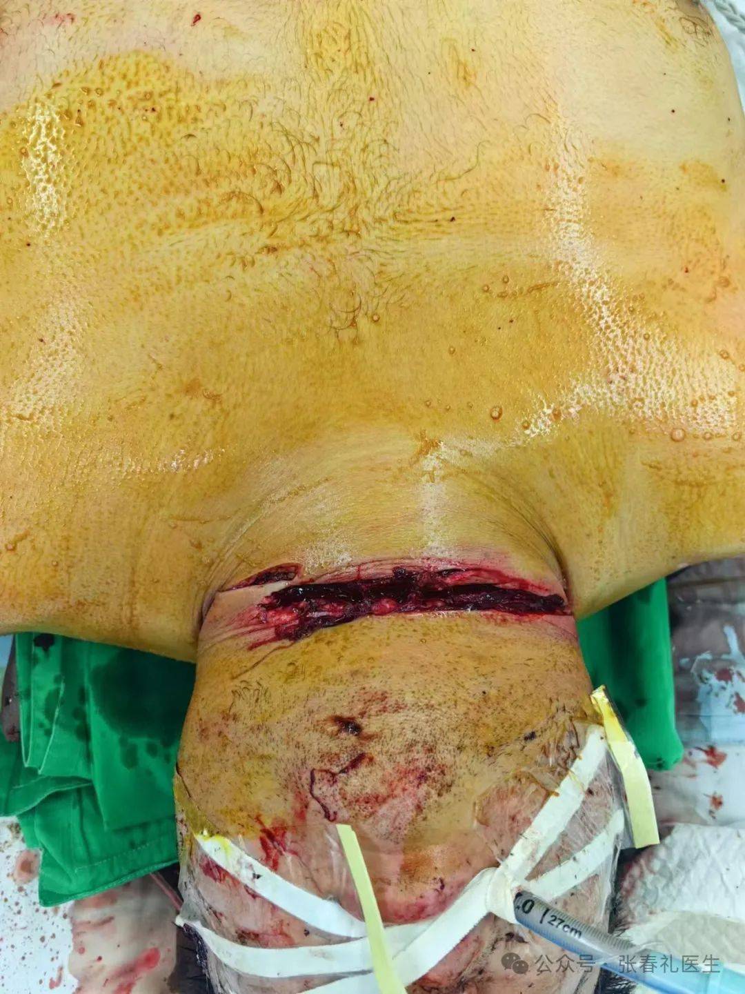 临床故事:一例颈部开放伤损伤气管的抢救._进行_病友_手术