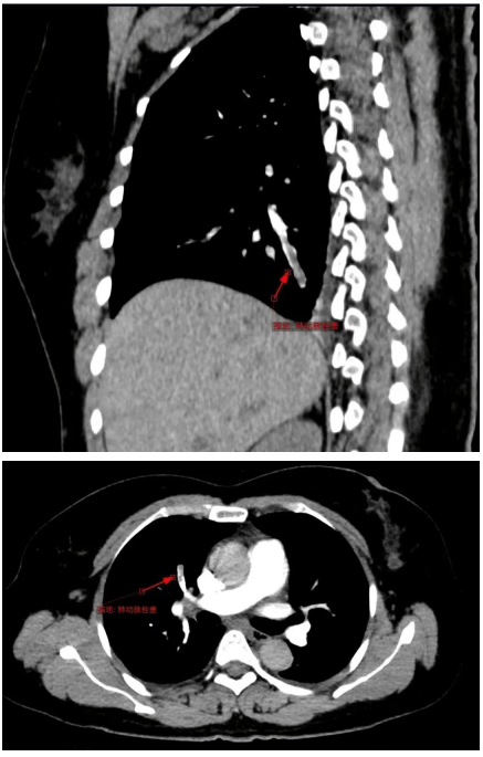 谁都可以做肺动脉cta吗?