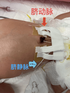 石狮市总医院首次开展脐动静脉联合置管术,成功抢救持续性肺动脉高压