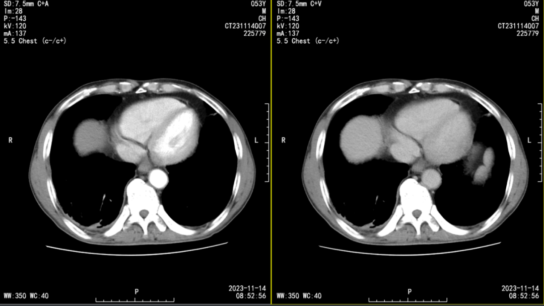 让人匪夷所思的「肺脓肿」,并非你所想_病灶_影像_复查