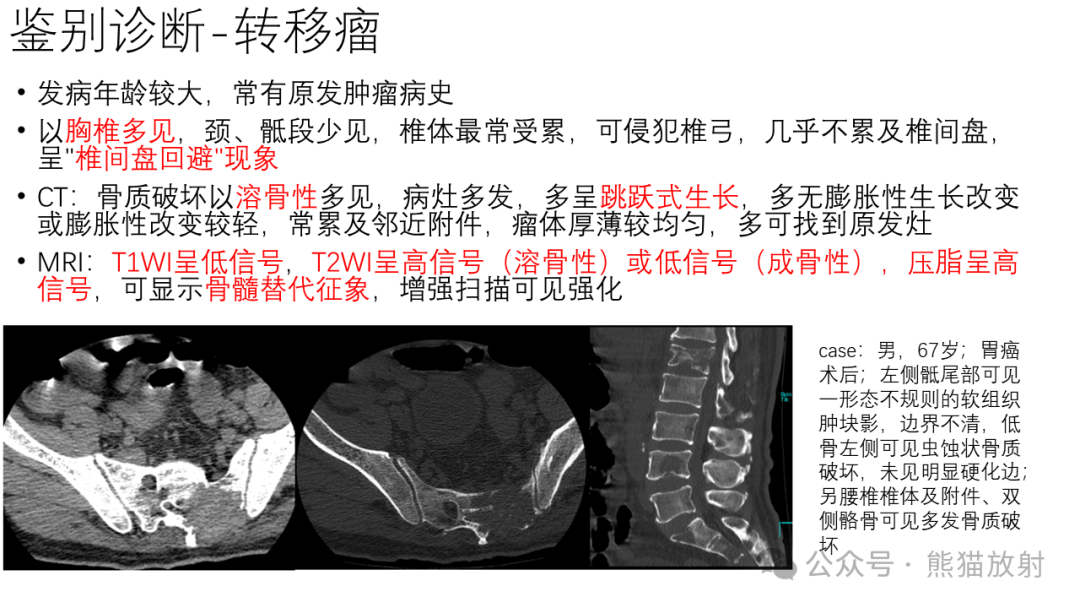 骶骨血管瘤图片