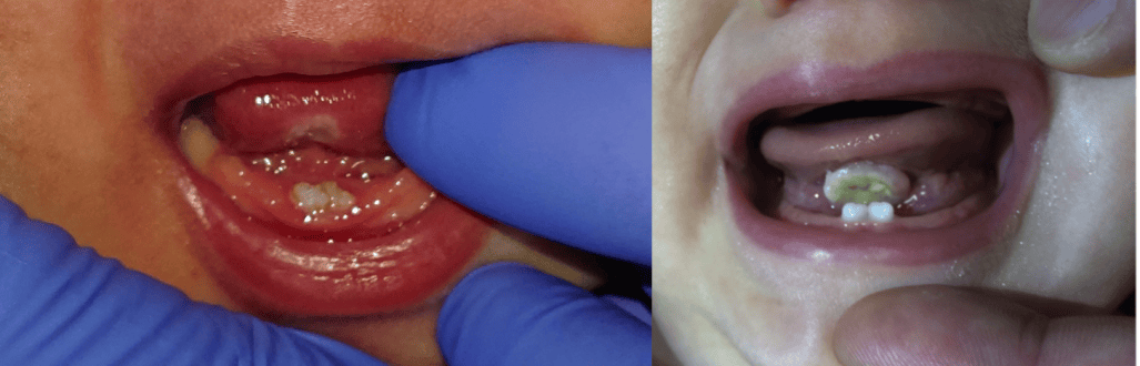 这个宝宝不一般,刚出生就长牙齿!