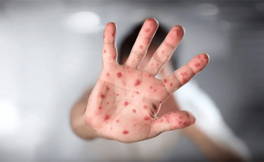 手足口病和疱疹性咽峡炎保持健康生活方式.