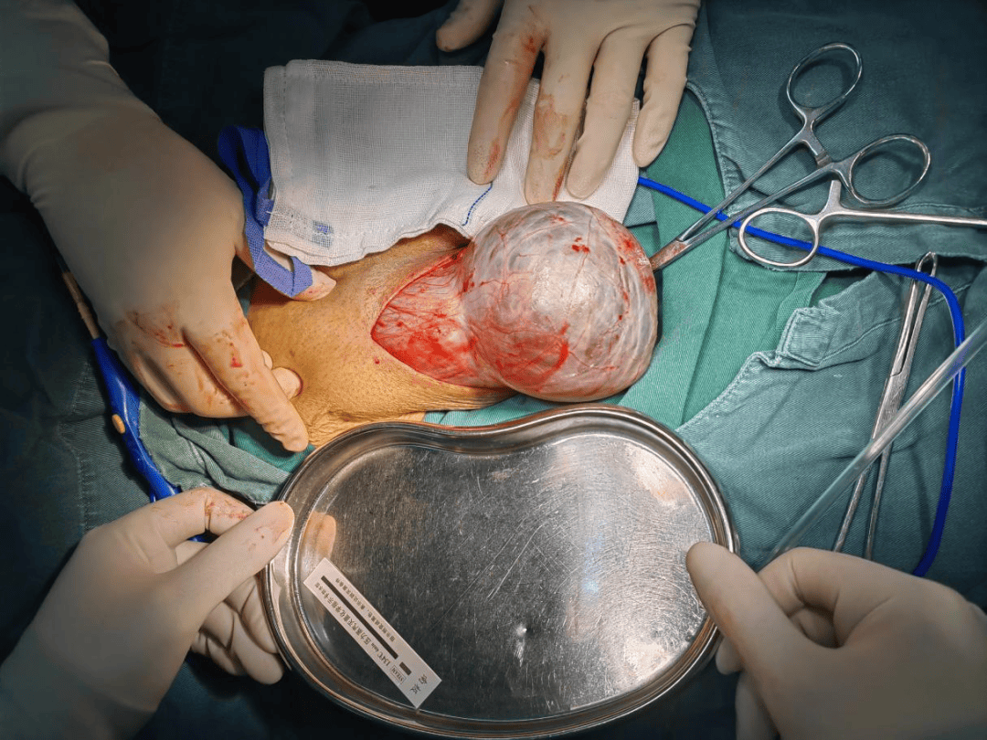 为了帮助叶老伯摆脱长达十余年的"拖油瓶",曹远志带领手术团队为叶