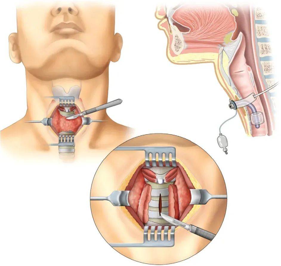 气管切开气囊放气图解图片