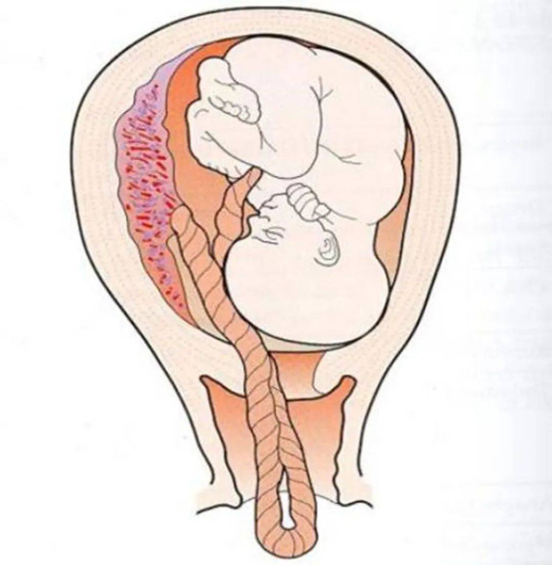 胎头着冠与拨露的图图片