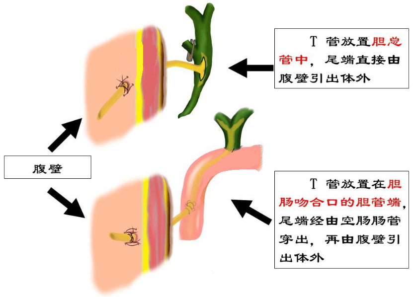 科普丨肝胆胰外科常用的t管,您了解多少