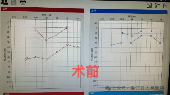 听力检查报告正常图片图片