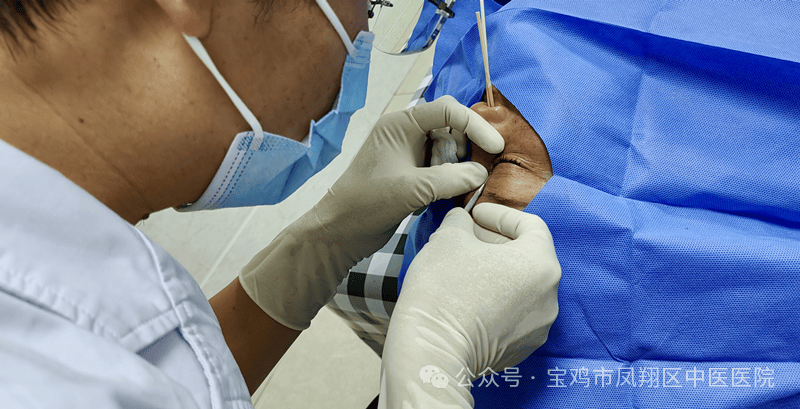 新技术之鼻泪道再通术——人工泪管置入术_手术_右眼_患者