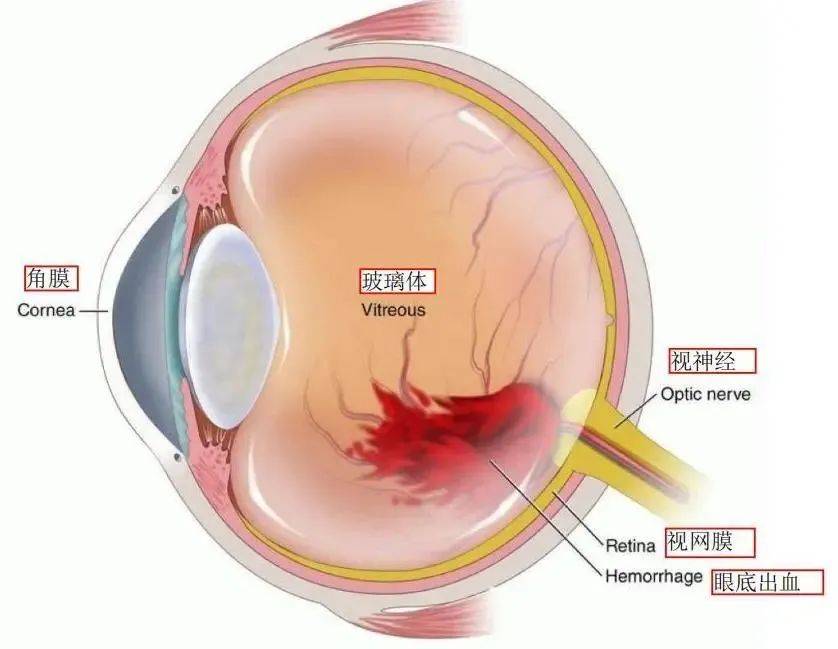 眼球新生血管图片图片