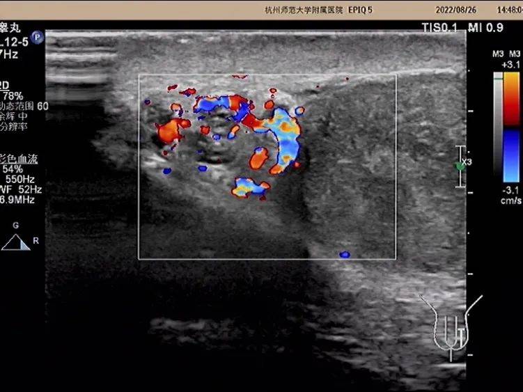 附睾超声测量图图片