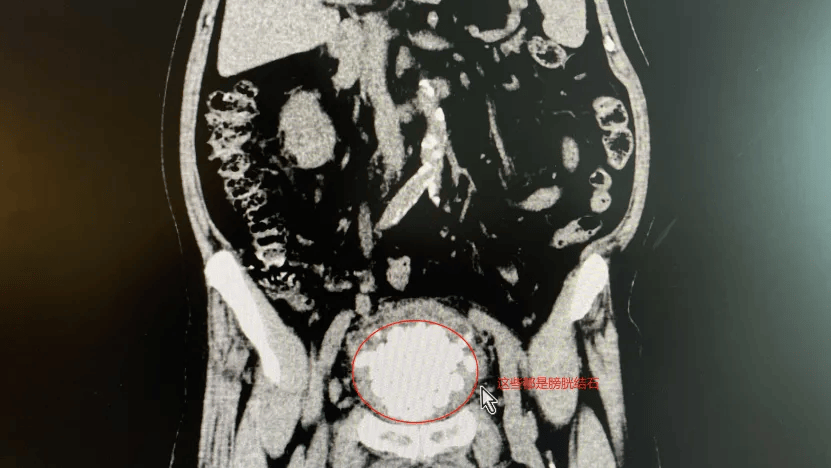 "掏到手酸"!广东祈福医院为87岁老人膀胱取出近300颗结石