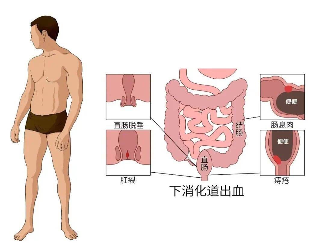 肛裂赘生物图片图片