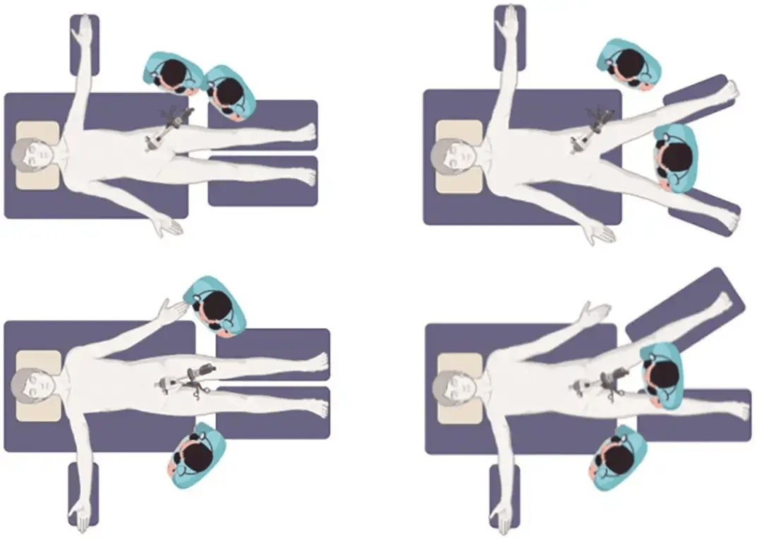 权威发布|单孔腹腔镜胆囊切除术中国专家共识