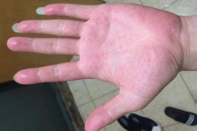 正常情况下,手掌应该是粉红色或略微偏白