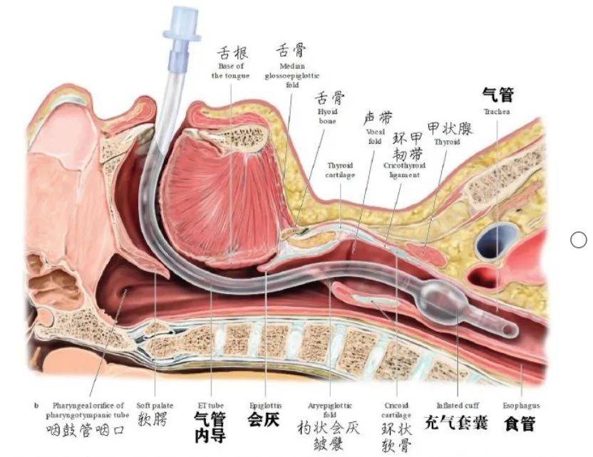 双腔气管导管图解图片