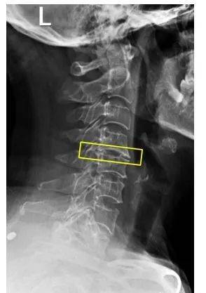 颈椎第五节滑脱图片图片