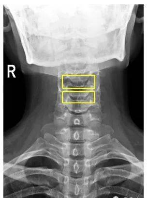 颈椎DR解剖图片